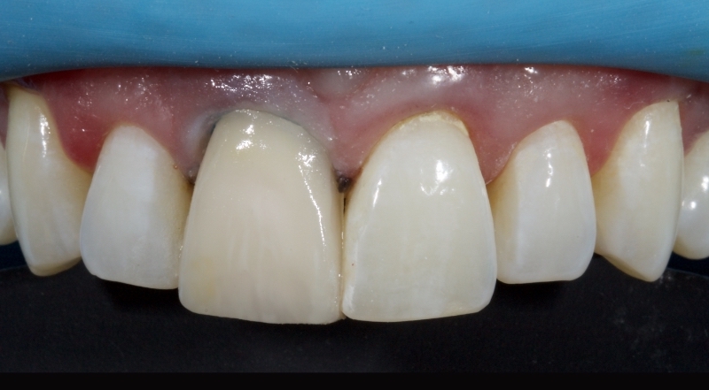 Advantages of Direct Composite Resin Veneers When Masking Tooth Discoloration Restorations Smithson advantages direct composite resin veneers 19