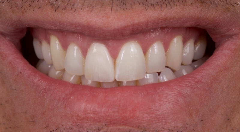 Advantages of Direct Composite Resin Veneers When Masking Tooth Discoloration Restorations Smithson advantages direct composite resin veneers 20