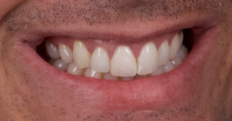 Advantages of Direct Composite Resin Veneers When Masking Tooth Discoloration Restorations Smithson advantages direct composite resin veneers 21