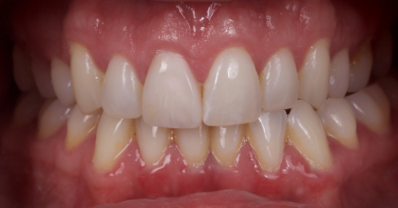 Advantages of Direct Composite Resin Veneers When Masking Tooth Discoloration Restorations Smithson advantages direct composite resin veneers 22