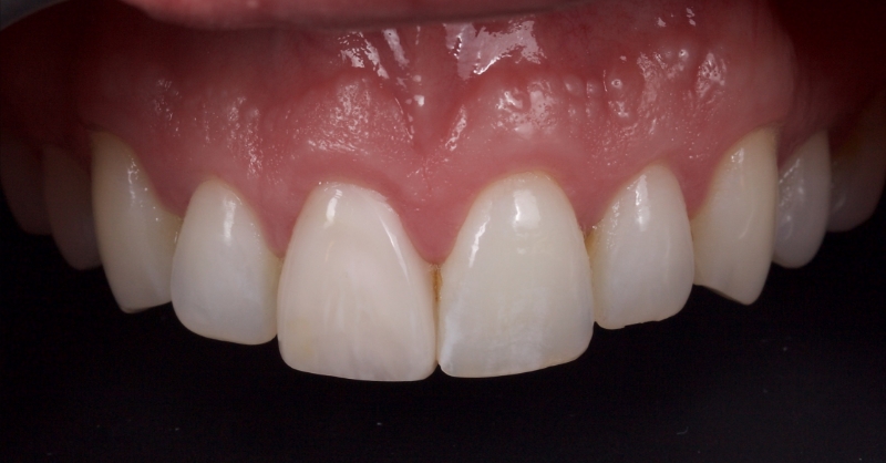 Advantages of Direct Composite Resin Veneers When Masking Tooth Discoloration Restorations Smithson advantages direct composite resin veneers 23