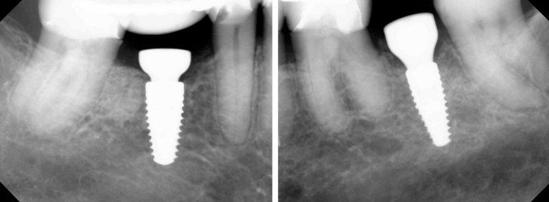 Screw Retained Posterior Implant Crown Restorative Challenges Winter screw retained posterior implant 01
