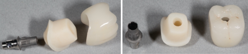 Screw Retained Posterior Implant Crown Restorative Challenges Winter screw retained posterior implant 02