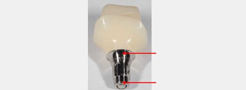 Screw Retained Posterior Implant Crown Restorative Challenges Winter screw retained posterior implant 03