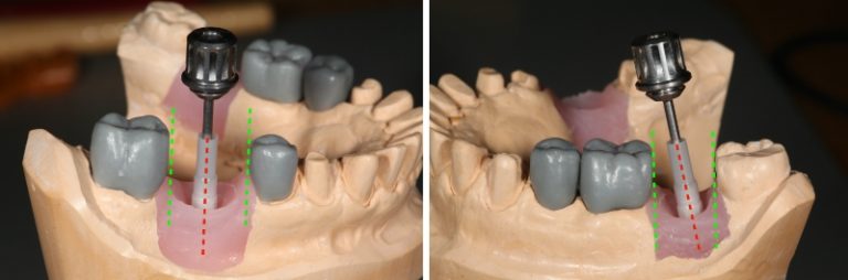 Screw Retained Posterior Implant Crown Restorative Challenges