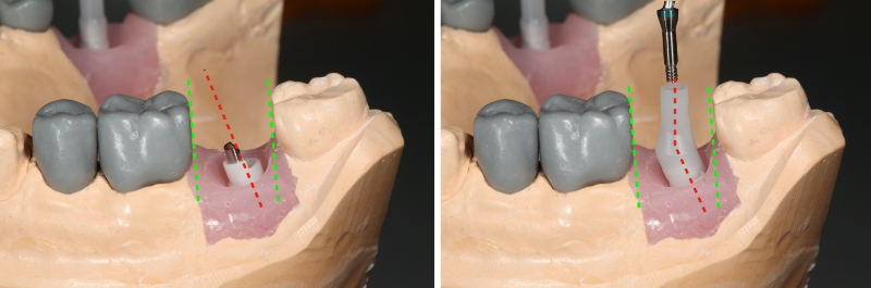 Screw Retained Posterior Implant Crown Restorative Challenges Winter screw retained posterior implant 05