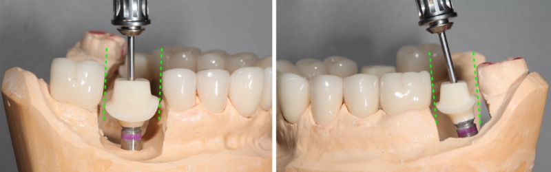 Screw Retained Posterior Implant Crown Restorative Challenges Winter screw retained posterior implant 06