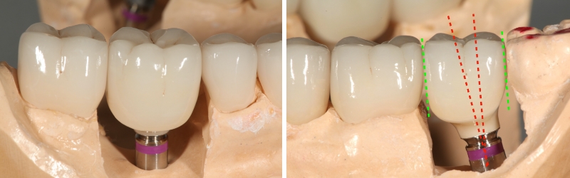 Screw Retained Posterior Implant Crown Restorative Challenges Winter screw retained posterior implant 07