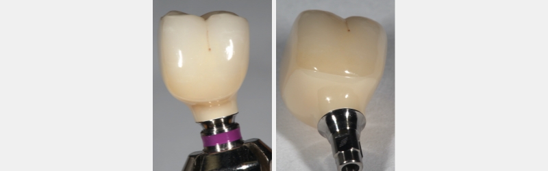 Screw Retained Posterior Implant Crown Restorative Challenges Winter screw retained posterior implant 08