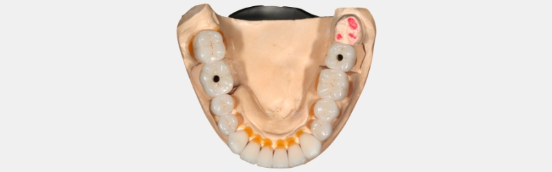 Screw Retained Posterior Implant Crown Restorative Challenges Winter screw retained posterior implant 09