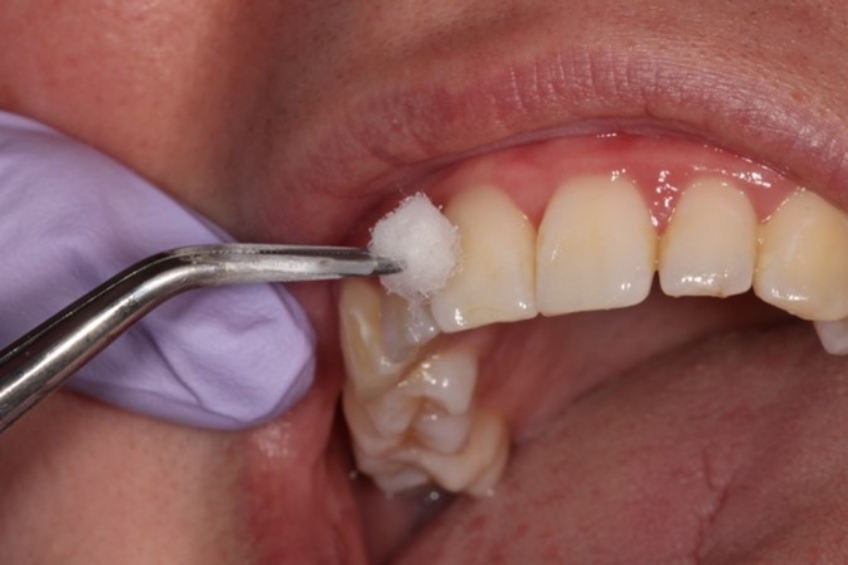 How Pulp Testing Can Benefit Restorative Dentistry AndyJaniga HowPulpTestCanBenefitDent Fig.2