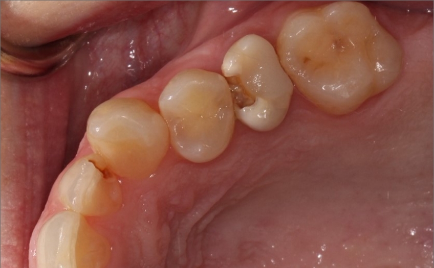 How Pulp Testing Can Benefit Restorative Dentistry AndyJaniga HowPulpTestCanBenefitDent Fig.3