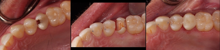 How Pulp Testing Can Benefit Restorative Dentistry AndyJaniga HowPulpTestCanBenefitDent Fig.4