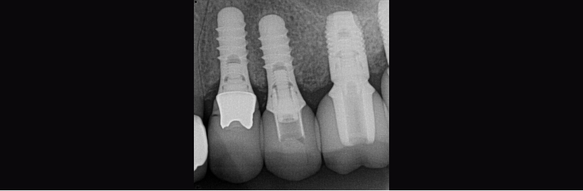 Tips to Remove a Damaged Straumann Solid Abutment Carson tips remove damaged abutment 01
