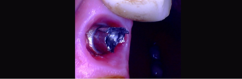 Tips to Remove a Damaged Straumann Solid Abutment Carson tips remove damaged abutment 02