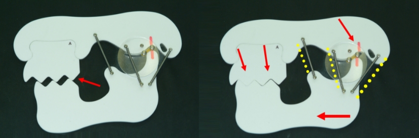 The Significance of Centric Relation When Preparing Posterior Crowns Bonk significance centric relation 01