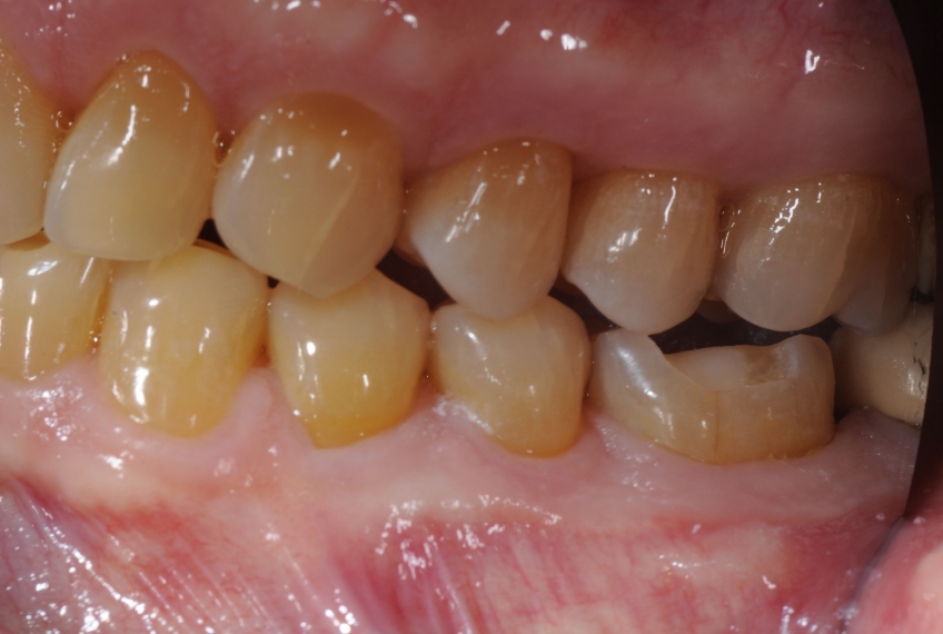 The Significance of Centric Relation When Preparing Posterior Crowns Bonk significance centric relation 02 1