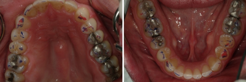 The Significance of Centric Relation When Preparing Posterior Crowns Bonk significance centric relation 03 1