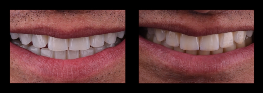 Four Key Elements of Esthetic Dentistry and the Importance of the Prototype Mitrani four key elements esthetic 03