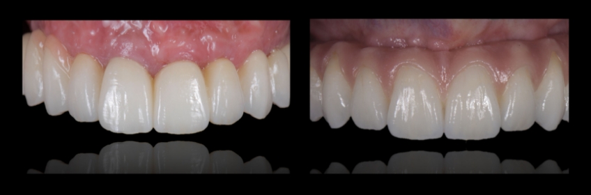 Four Key Elements of Esthetic Dentistry and the Importance of the Prototype Mitrani four key elements esthetic 05