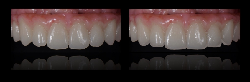 Four Key Elements of Esthetic Dentistry and the Importance of the Prototype Mitrani four key elements esthetic 06