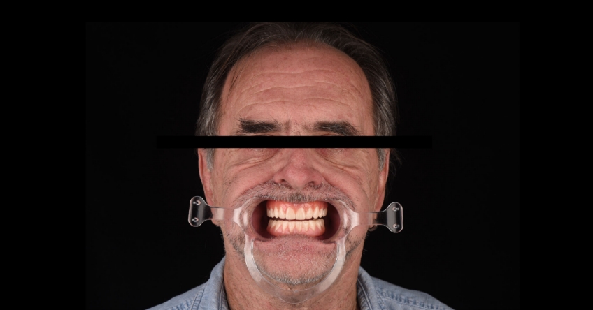 Four Key Elements of Esthetic Dentistry and the Importance of the Prototype Mitrani four key elements esthetic 07
