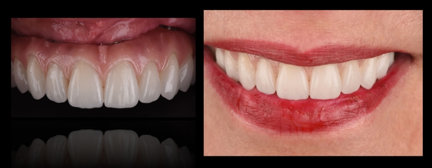 Four Key Elements of Esthetic Dentistry and the Importance of the Prototype Mitrani four key elements esthetic 08