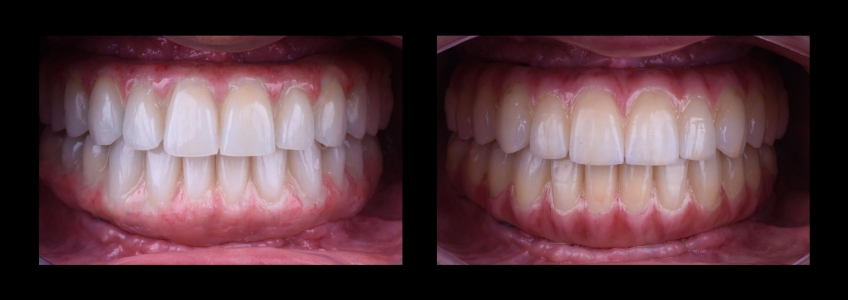 Four Key Elements of Esthetic Dentistry and the Importance of the Prototype Mitrani four key elements esthetic 09