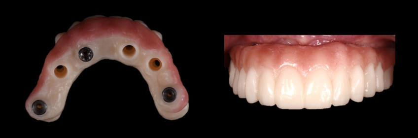 Four Key Elements of Esthetic Dentistry and the Importance of the Prototype Mitrani four key elements esthetic 10