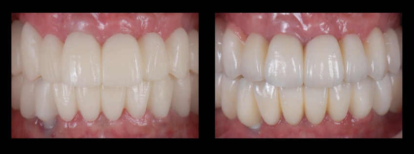 Four Key Elements of Esthetic Dentistry and the Importance of the Prototype Mitrani four key elements esthetic 12