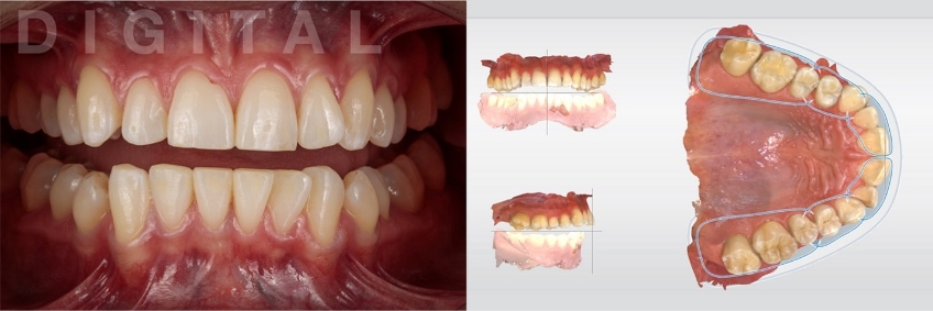 A Digital Approach to Occlusal Appliance Fabrication Dichter digital approach occlusal appliance 04