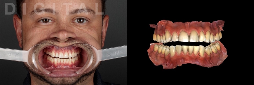 A Digital Approach to Occlusal Appliance Fabrication Dichter digital approach occlusal appliance 05