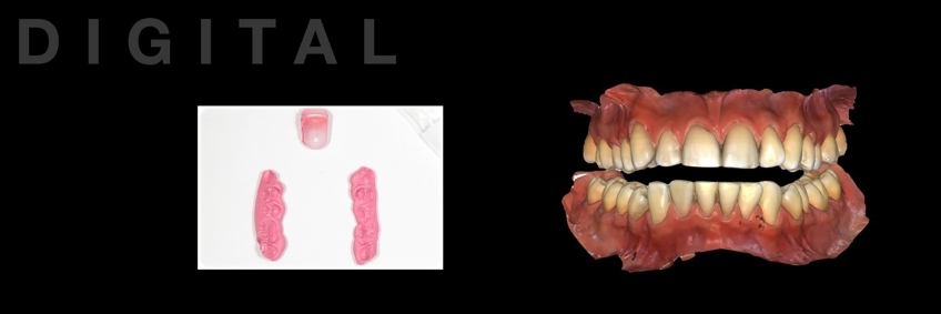 A Digital Approach to Occlusal Appliance Fabrication Dichter digital approach occlusal appliance 06