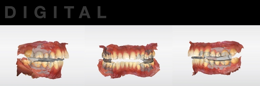 A Digital Approach to Occlusal Appliance Fabrication Dichter digital approach occlusal appliance 07