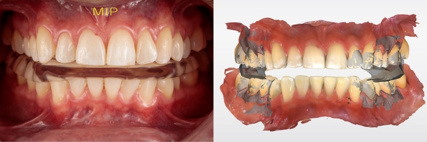 A Digital Approach to Occlusal Appliance Fabrication Dichter digital approach occlusal appliance 10