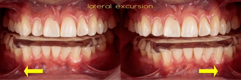 A Digital Approach to Occlusal Appliance Fabrication Dichter digital approach occlusal appliance 11