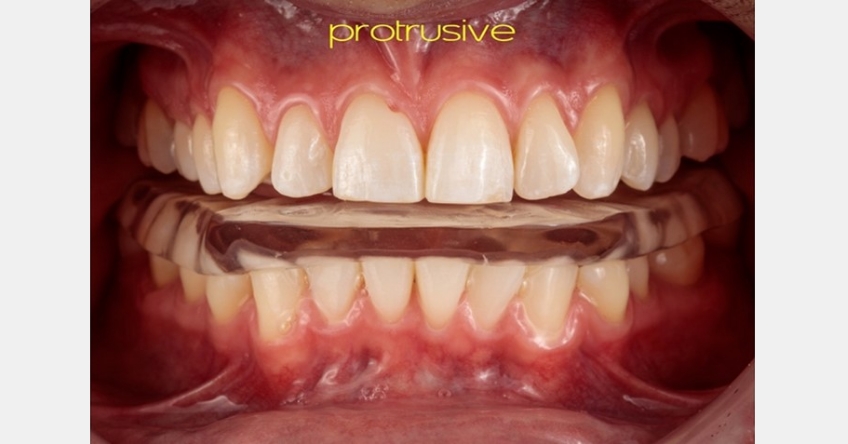 A Digital Approach to Occlusal Appliance Fabrication Dichter digital approach occlusal appliance 12