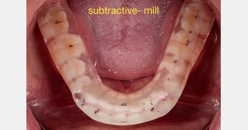 A Digital Approach to Occlusal Appliance Fabrication Dichter digital approach occlusal appliance 13