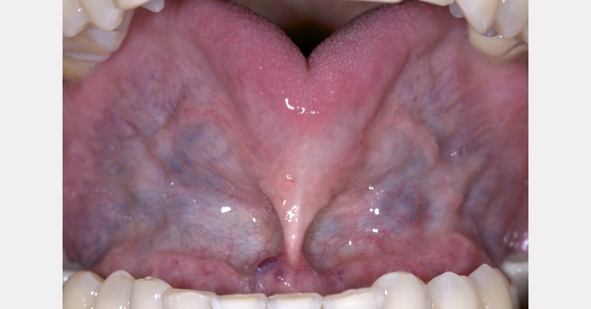 Tongue Tie and Sleep Apnea: The Craniofacial Connection JeffRouse TongueTieSleepApnea FeaturedImage