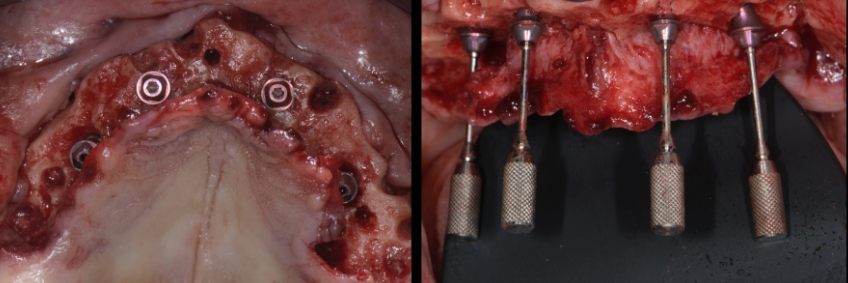 Mitrani getting sra abutment right 01