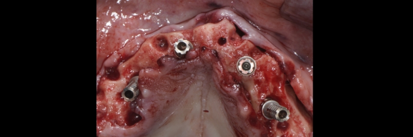 Mitrani getting sra abutment right 02