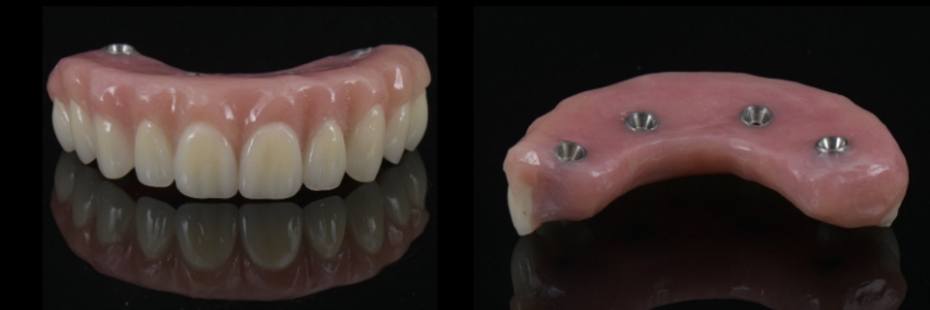 Mitrani getting sra abutment right 04