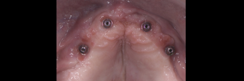 Mitrani getting sra abutment right 06
