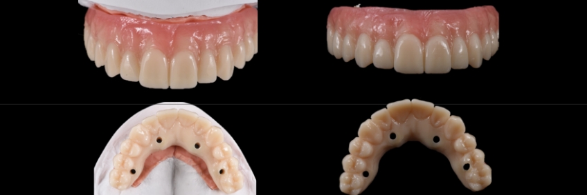 Mitrani getting sra abutment right 07