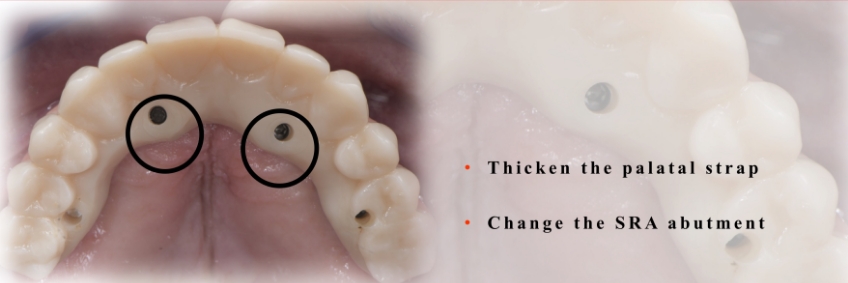 Mitrani getting sra abutment right 08