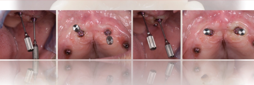 Mitrani getting sra abutment right 09