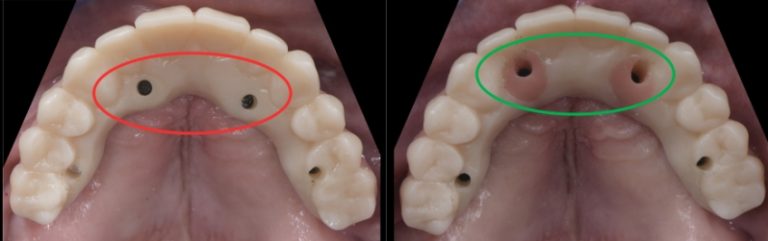 Mitrani getting sra abutment right 10