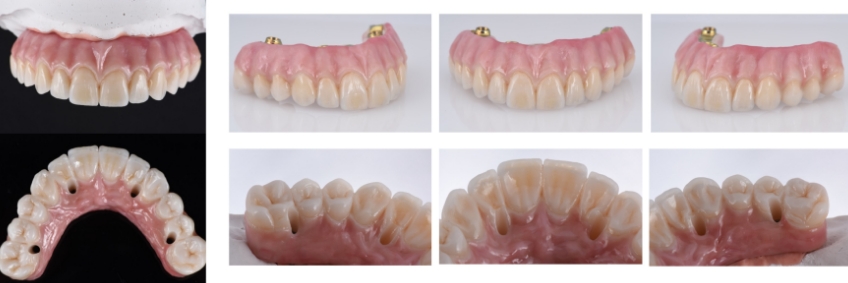 Mitrani getting sra abutment right 11