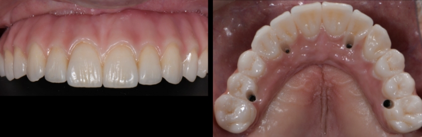 Mitrani getting sra abutment right 13 1