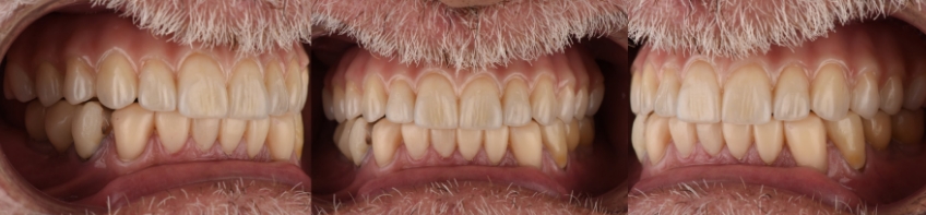 Mitrani getting sra abutment right 2